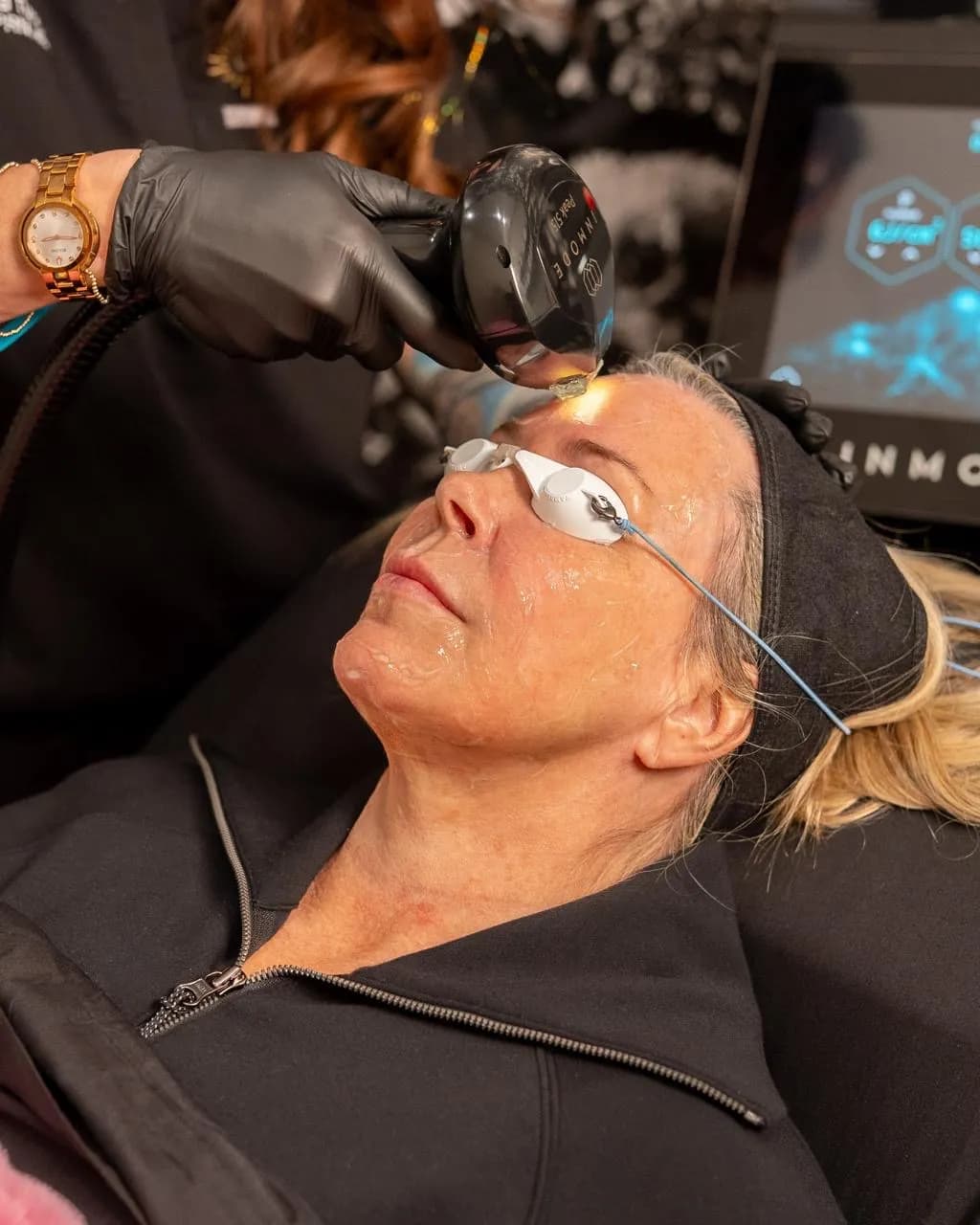 Lumecca Peak IPL Photofacial