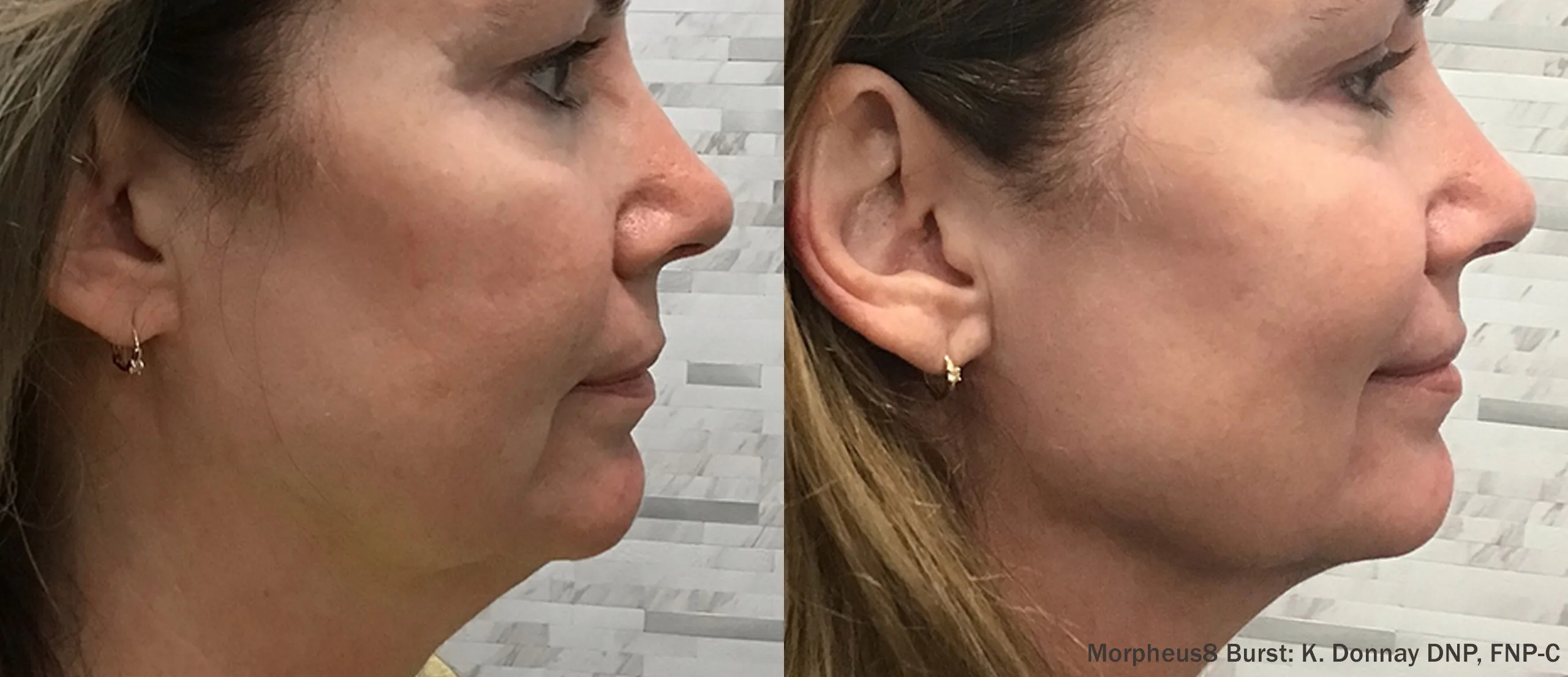 Before — Before and after Morpheus8 Burst treatment showing tightened jawline, credited to K. Donnay DNP, FNP-C