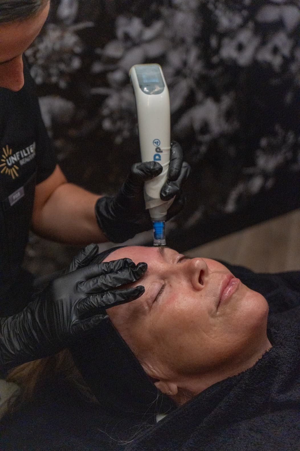 Microneedling