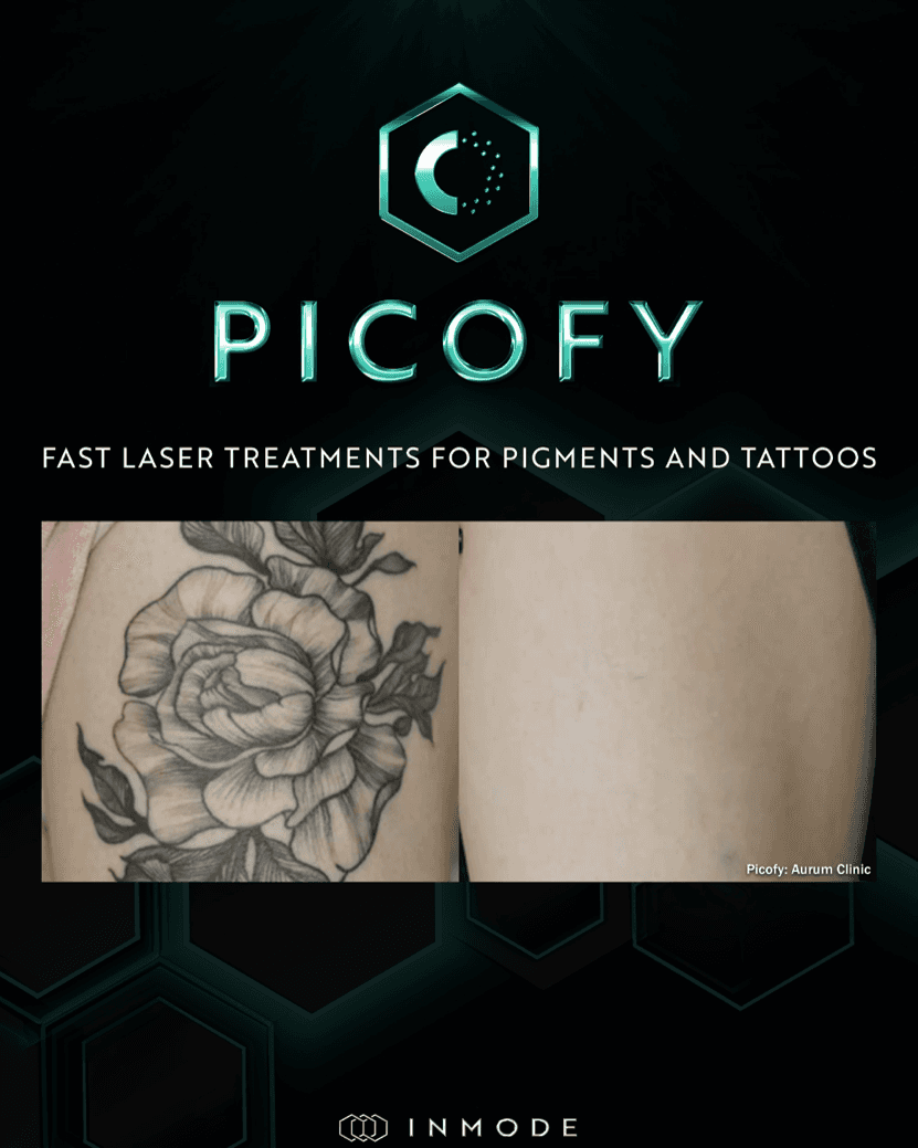 A PicoFy by InMode card reading "fast laser treatments for pigments and tattoos", above a before-and-after of a floral tattoo credited to Aurum Clinic