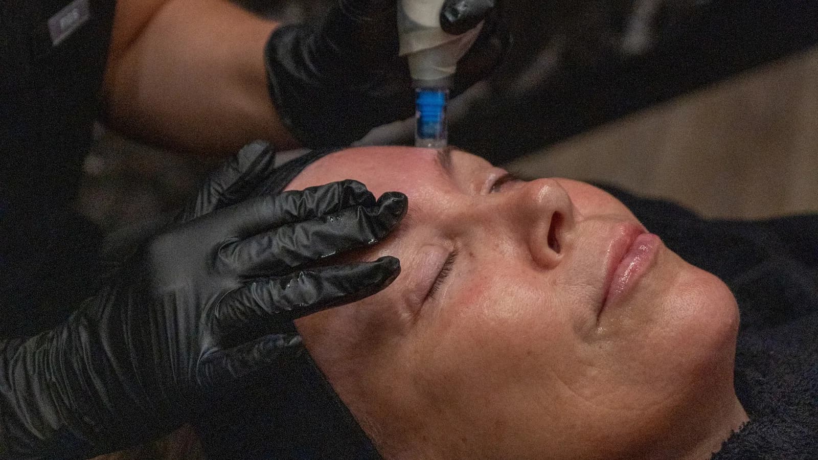 Benefits of Microneedling: Healthier, Rejuvenated Skin