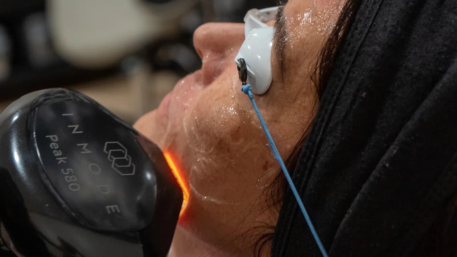 Lumecca: The Breakthrough IPL Treatment Transforming Skin in Georgia